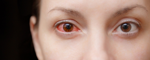 Rotes Auge Ausschnitt 500 Fotolia_195652332_L (1)